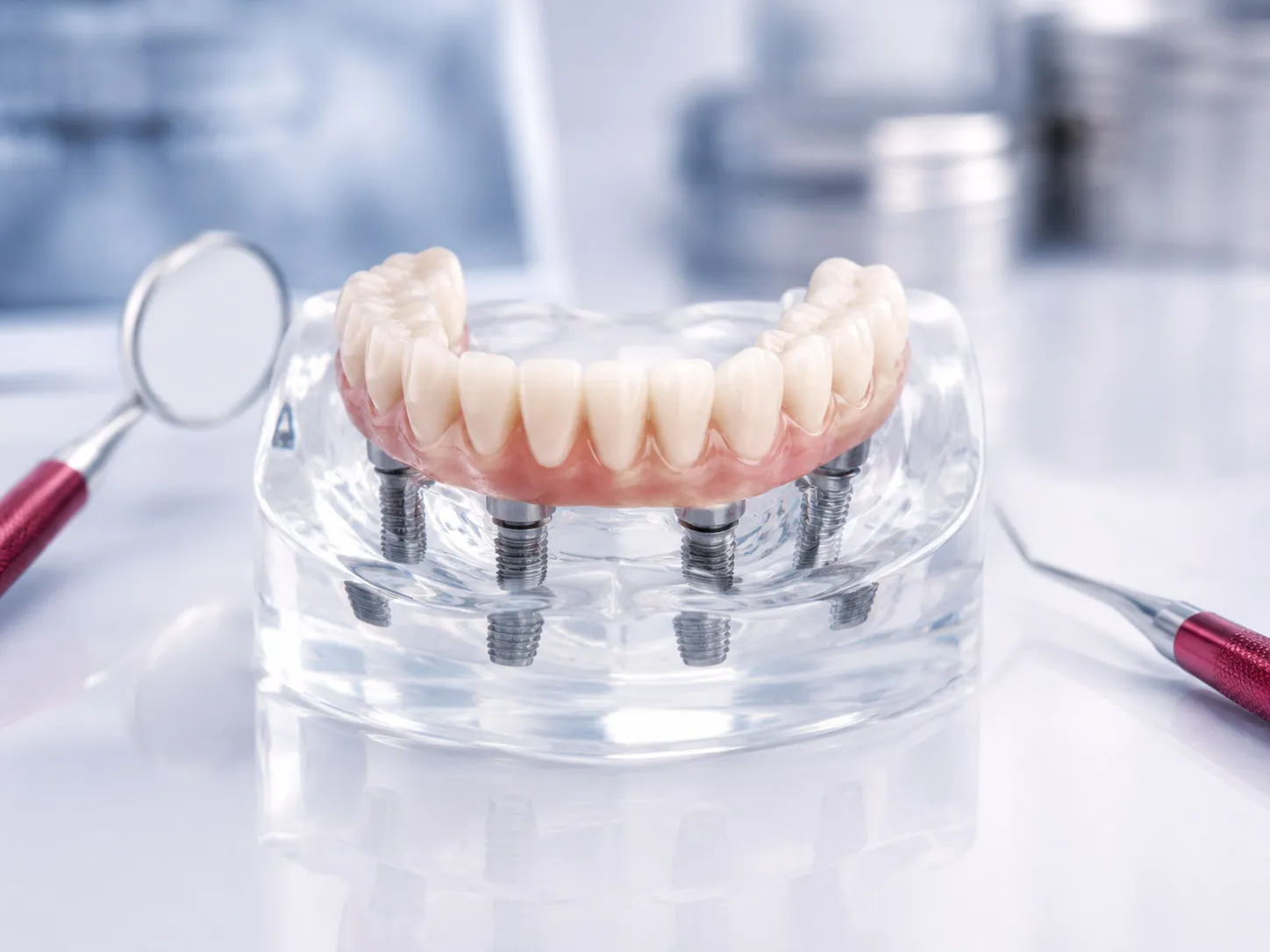 Modelo de prótese total fixa apoiada em quatro implantes