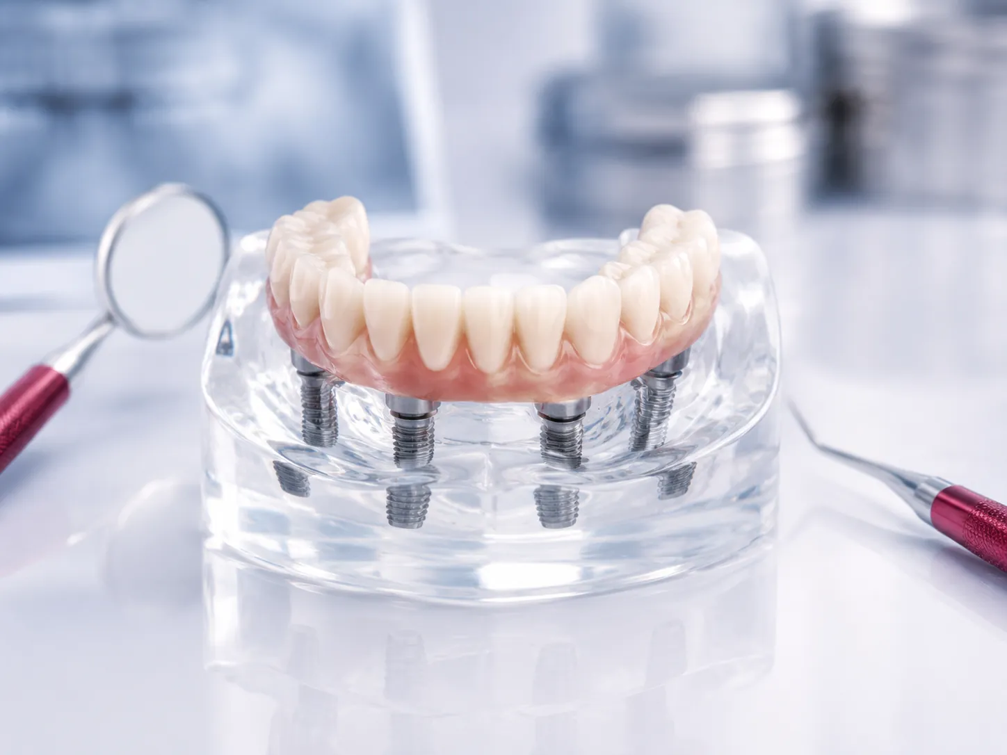 Modelo de prótese total apoiada em quatro implantes na arcada inferior