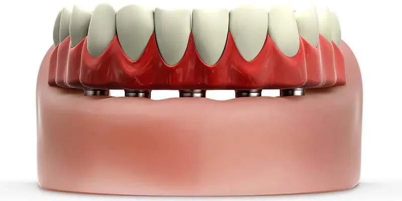 Prótese Protocolo: o que é, custos, durabilidade e mais