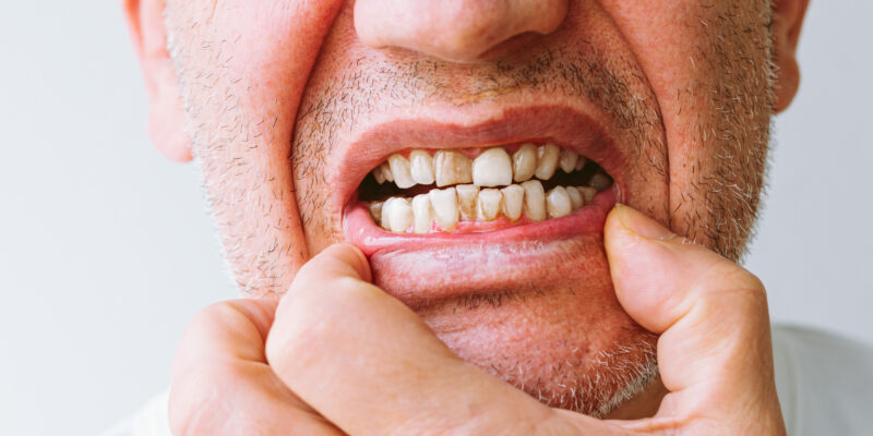 Doença Periodontal: Causas, Sintomas e Tratamentos