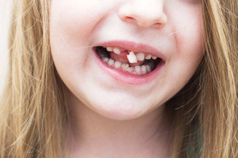 menina movendo seu dente frontal de leite com a língua na boca aberta.