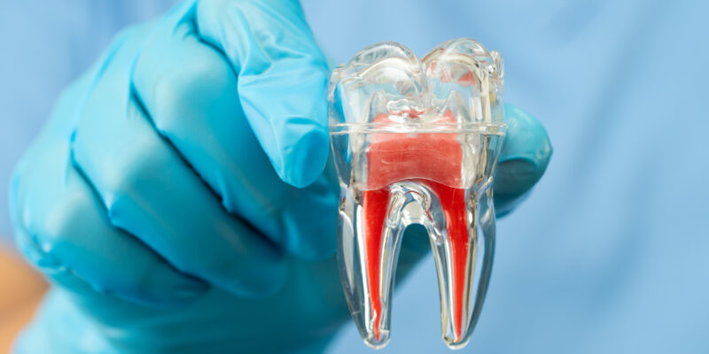 Endodontia: entenda o tratamento e seus benefícios