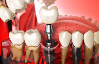 Implantes dentários: tudo o que você precisa saber antes do procedimento