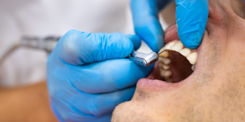 Guia completo sobre prótese protocolo: tire suas dúvidas