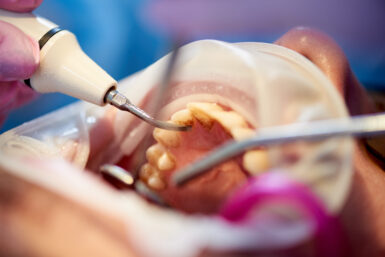 Remoção de tártaro: saiba como cuidar da sua saúde bucal de forma eficaz