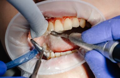 Gengiva sangrando: pode ser doença periodontal?