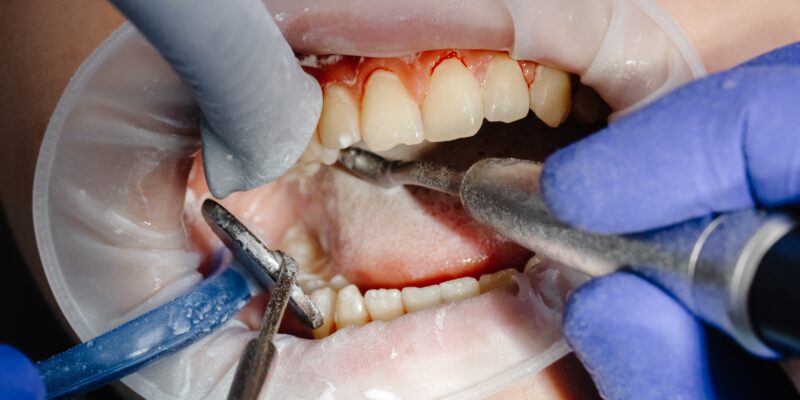 Gengiva sangrando: pode ser doença periodontal?