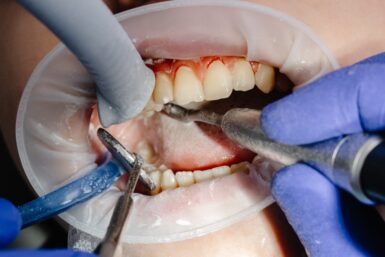 Gengiva sangrando: pode ser doença periodontal?