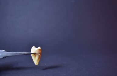 Extração de siso: tudo o que você precisa saber antes de remover o dente