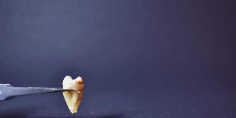 Extração de siso: tudo o que você precisa saber antes de remover o dente