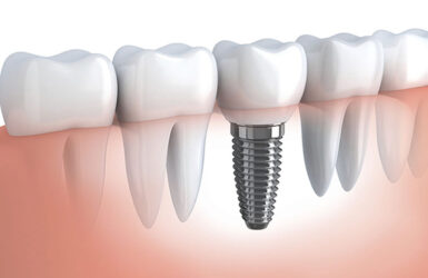 protese-dentaria-versus-implante-dentario