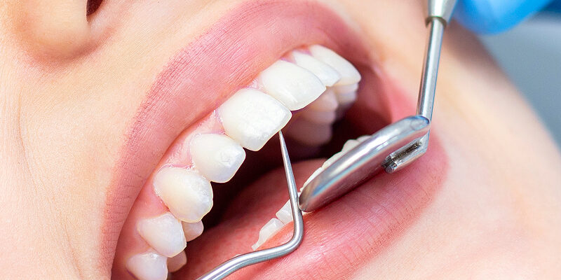 Faceta de Porcelana_ Vantagens e Quando Fazer _ Siguimi