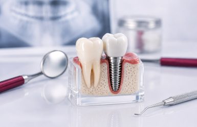 implante-dentario-goiania