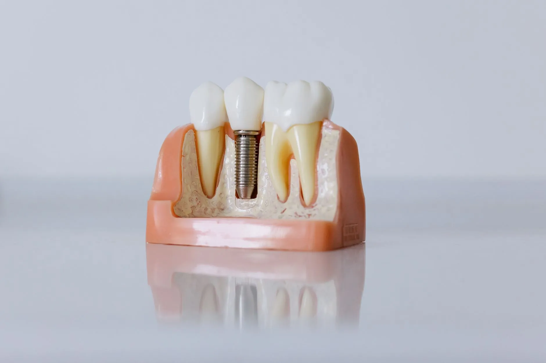 linha do tempo recuperação implante dentário quanto tempo dói após procedimento