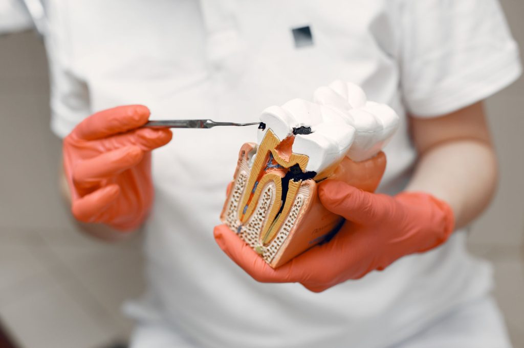 lente de porcelana comparada à faceta convencional em corte transversal do dente