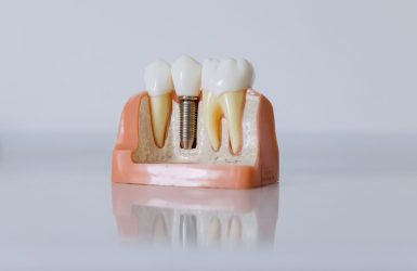 tipos-de-implante-dentario-por-que-a-escolha-do-tipo-de-implante-dentario-import