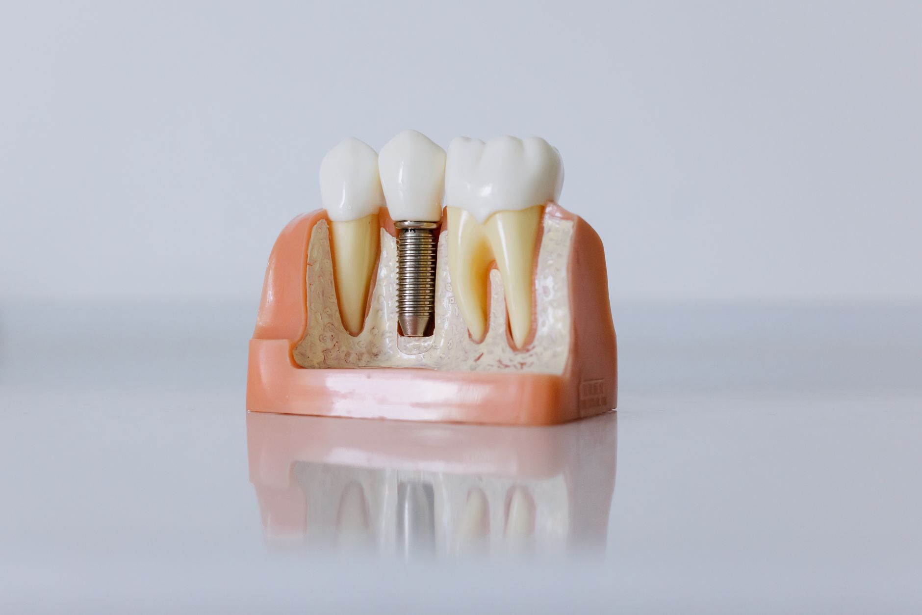 tipos-de-implante-dentario-por-que-a-escolha-do-tipo-de-implante-dentario-import